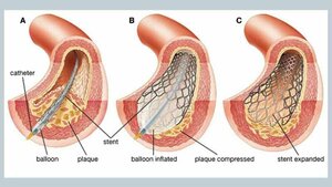 Coronary Angioplasty