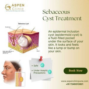 Sebaceous Cyst Treatment | Dr. Hina Khan