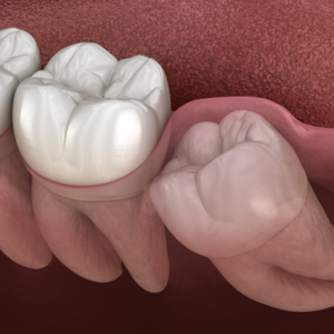 Removal Of Decayed or Wisdom Teeth at Dixit Dental Clinic
