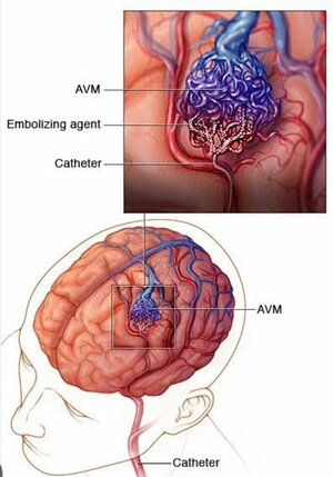 Arteriovenous Malformations (AVMs) of the Head, Neck, and Face | Dr. Maunil Bhuta
