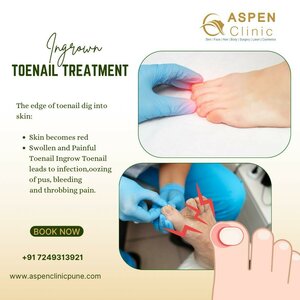 Ingrown Toenail Treatment | Dr. Hina Khan
