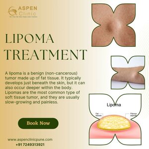 Lipoma Treatment | Dr. Hina Khan