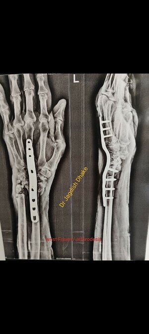 Wrist Arthrodesis in Swargate, Pune