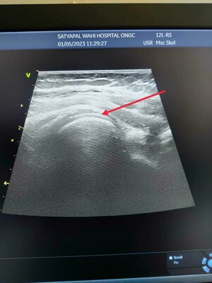 Shoulder Ultrasound - Easy and Inexpensive way of Diagnosing Shoulder Pain
