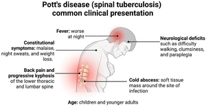 Symptoms of Spine Tuberculosis