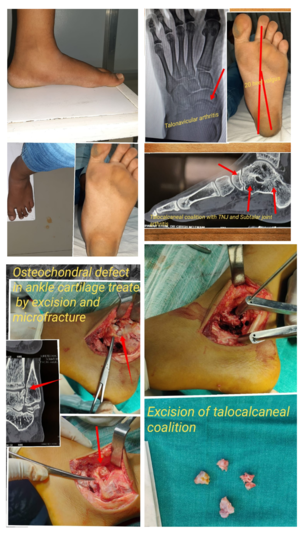 Flat foot deformity correction by Dr. Girish Motwani