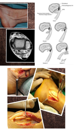 How do I manage peroneal tendon subluxation? Dr. Girish Motwani