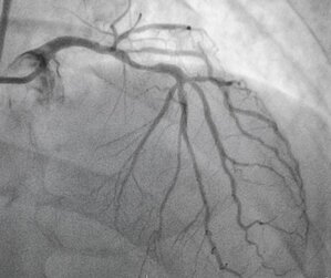 Angiography 