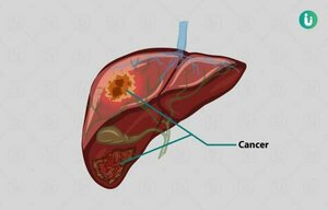 Liver Cancer