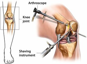 Arthroscopic surgery
