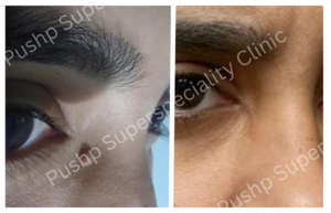 Benign Skin Tumor Removal with Dermato Surgery: Dr. Sandeep Naphade\'s