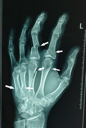 Fractures marked with arrowheads.
