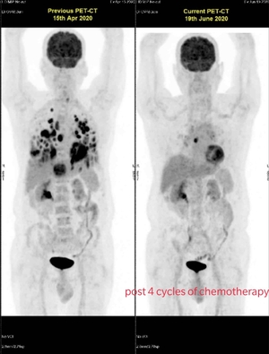 Chemotherapy in Stage 4 lung cancer | Dr. Rahul Kulkarni