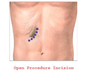 Laparoscopic Cholecystectomy | Dr. Sameer Badami