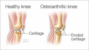 Osteoarthritis