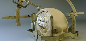 Stereotactic surgery - Dr. Palak Jaiswal