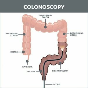 Colonoscopy