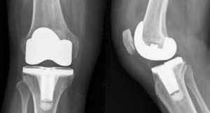Knee Replacement