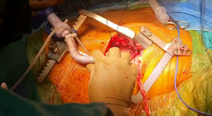 MICS-CABG - Dr. Kishor Deore