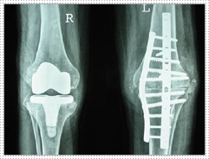 Total Knee Replacement in a Case of Haemophilia - Dr Shreedhar Archik
