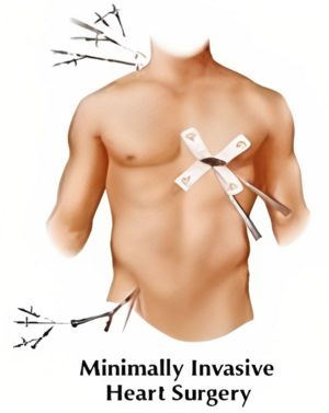 Minimally Invasive Heart Surgery - Dr. Kishor Deore