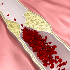 Atherosclerosis - Symptom, Cause and Treatment | Dr. Rahul Chalwade