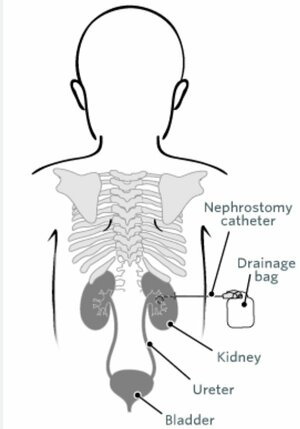 Percutaneous nephrostomy | Dr. Maunil Bhuta