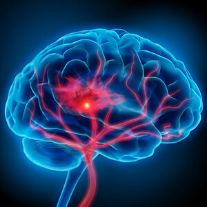 Neurovascular Surgery- Dr. Palak Jaiswal