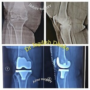 Total knee replacement surgery in Swargate