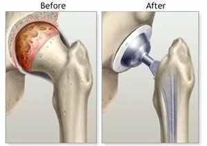 Total Hip Replacement
