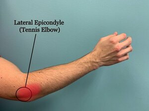 Tennis Elbow Treatment in Navi Mumbai | Dr. Sonal Bansal