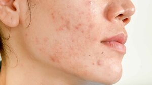 Acne Scars