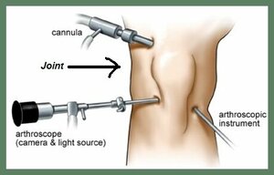 Knee Arthroscopy
