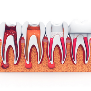 Vital Pulp Therapies in Prabhat Road Pune | Dixit Dental Clinic