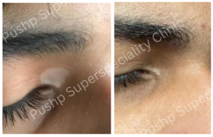 Vitiligo Treatment Achieve Complete Recovery - Dr. Sandeep Naphade