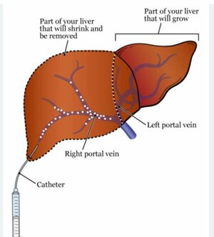Portal Vein Embolization | Dr. Maunil Bhuta