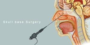 Skull Base Surgery - Dr. Palak Jaiswal