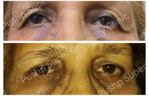 Blepharoplasty Surgery by Dr. Sandeep Naphade