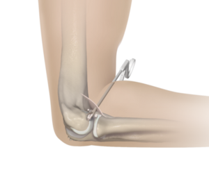 Elbow Arthroscopy Treatment in Navi Mumbai | Dr. Sonal Bansal