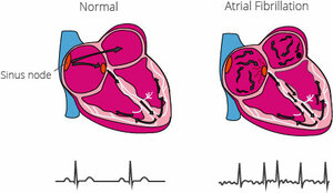Atrial Fibrillation
