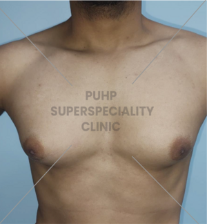 Bilateral Gynacomastia