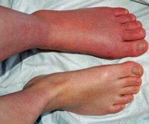 Complex Regional Pain Syndrome of Foot(CRPS)