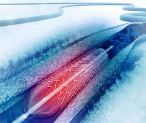 Angioplasty | Dr. Ishwar Zanwar