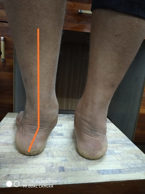 Flat Foot deformity - Dr Girish Motwani
