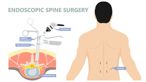 Advantages of Endoscopic Spine Surgery