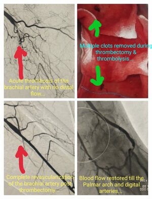 Photo : Brachial Artery Thrombectomy