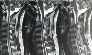 MRI showing C3-C4 PIVD with cervical myelopathy - Dr. Ajay Kothari - Spine Surgeon | Shivaji Nagar, Pune