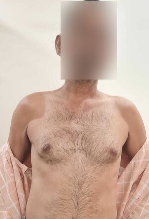 MICS AVR 3 WEEKS AFTER SURGERY