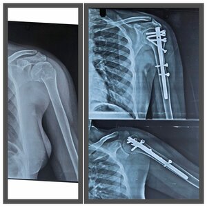 Minimally Invasive Nailing for Humerus Head Fracture: Pre &amp; Post-Op Results