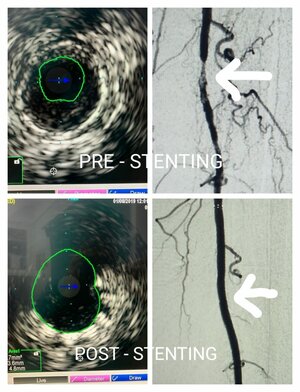 Photo : Performed Intravascular ultrasound (IVUS)